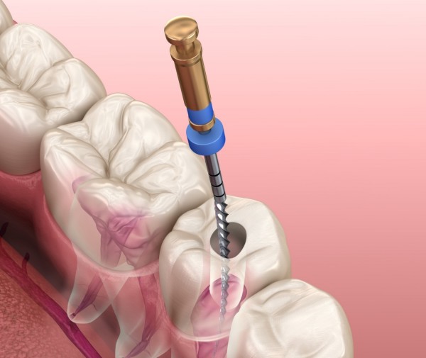 LE RETRAITEMENT ENDODONTIQUE