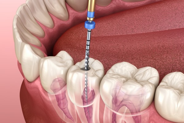 ENDODONTIE